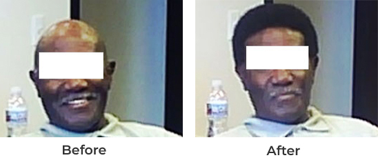 Image3 hair growth on on bold man