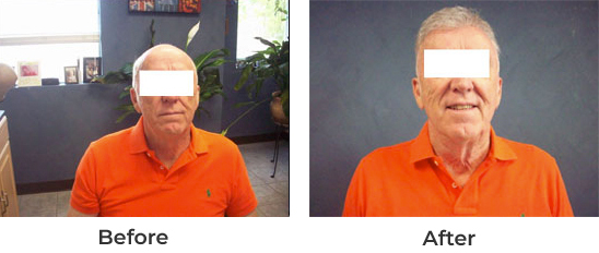 Image4 hair transplant