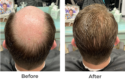 Hairbefore-2-122321 hair growth on on bold man