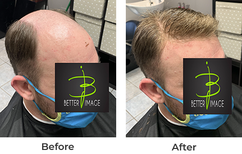 Hairbefore-1-122321 hair growth on on bold man